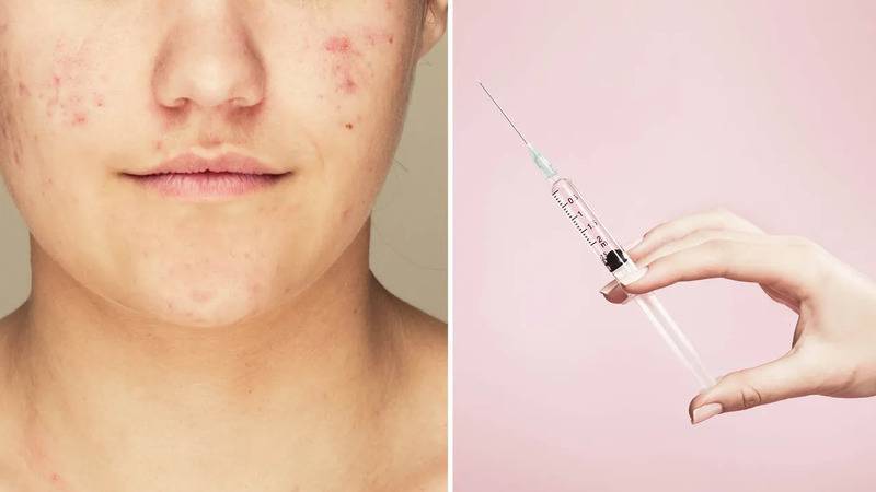 sivilceye karsi iki asi gelistiriliyor mrna denemesi ve enzim hedefli yaklasim jZHUwxXZ